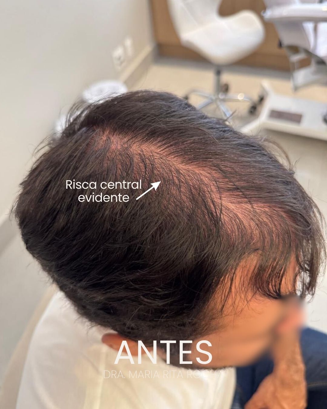 Antes — calvície masculina