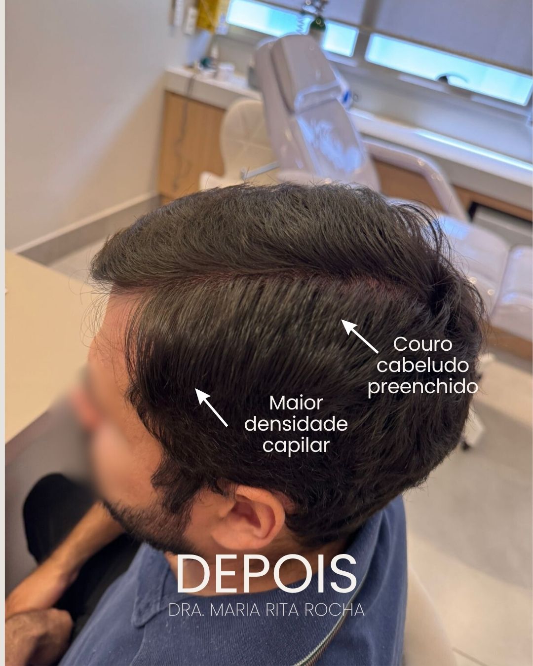 Depois — calvície masculina