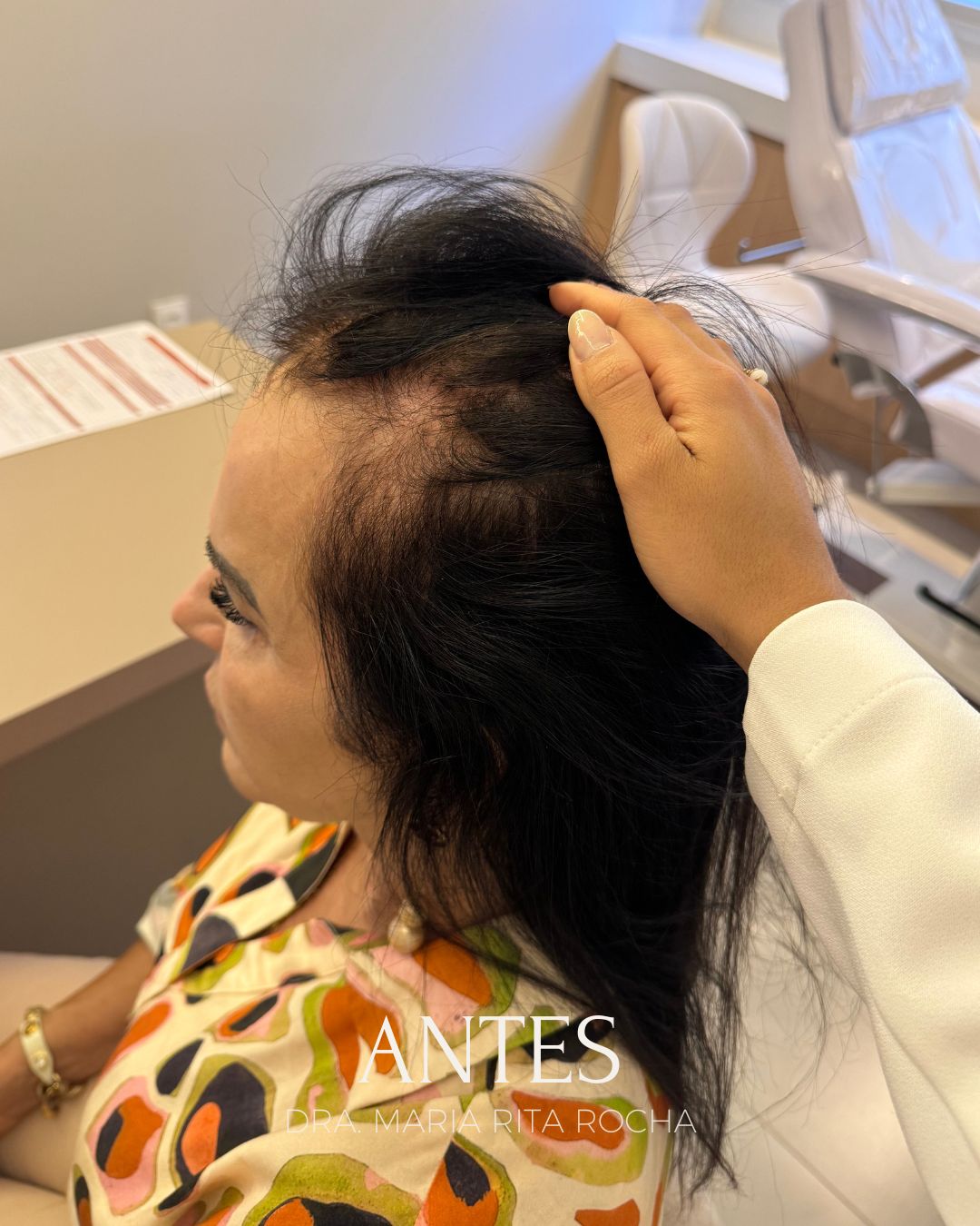 Antes do tratamento de queda de cabelo