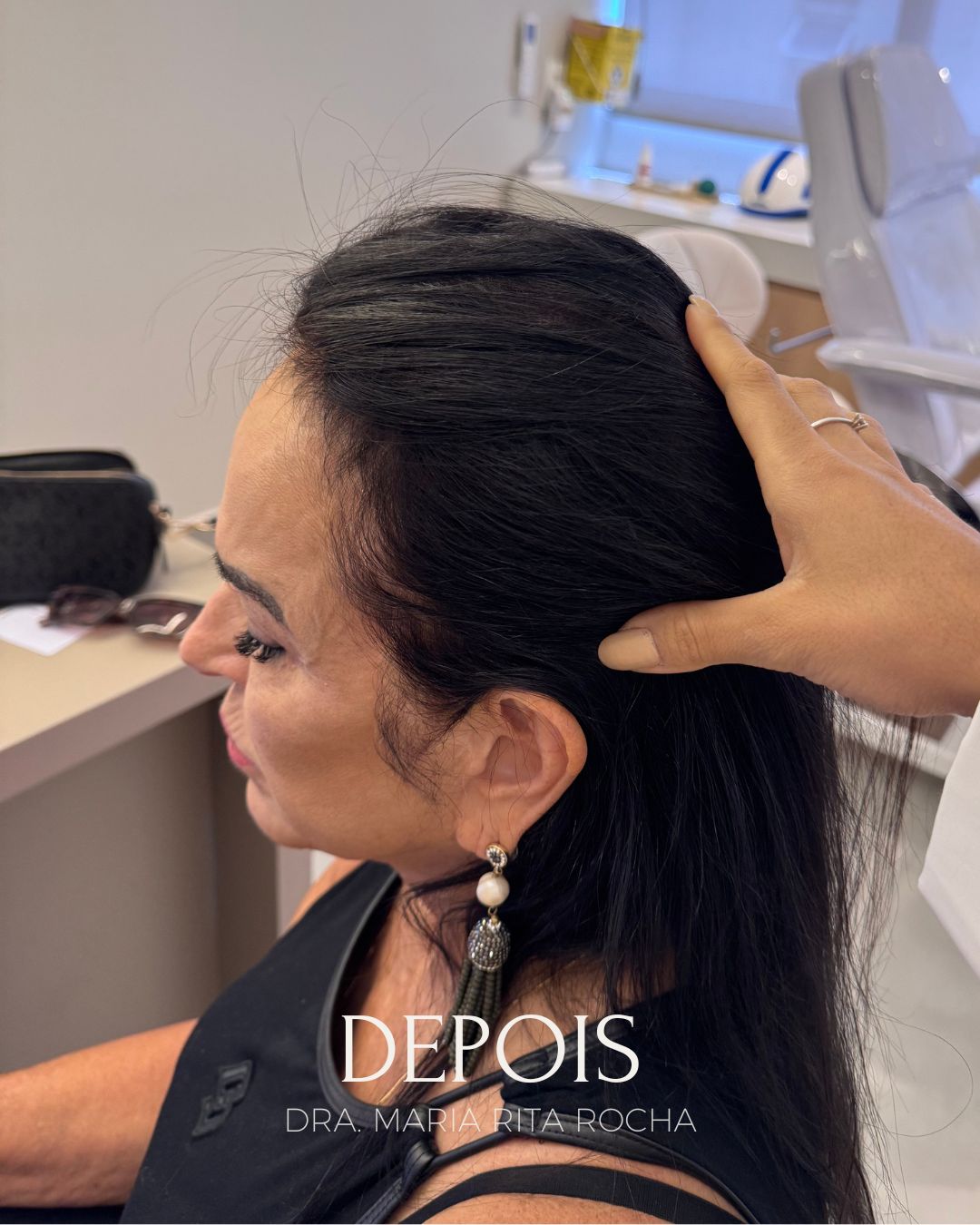 Depois do tratamento de queda de cabelo