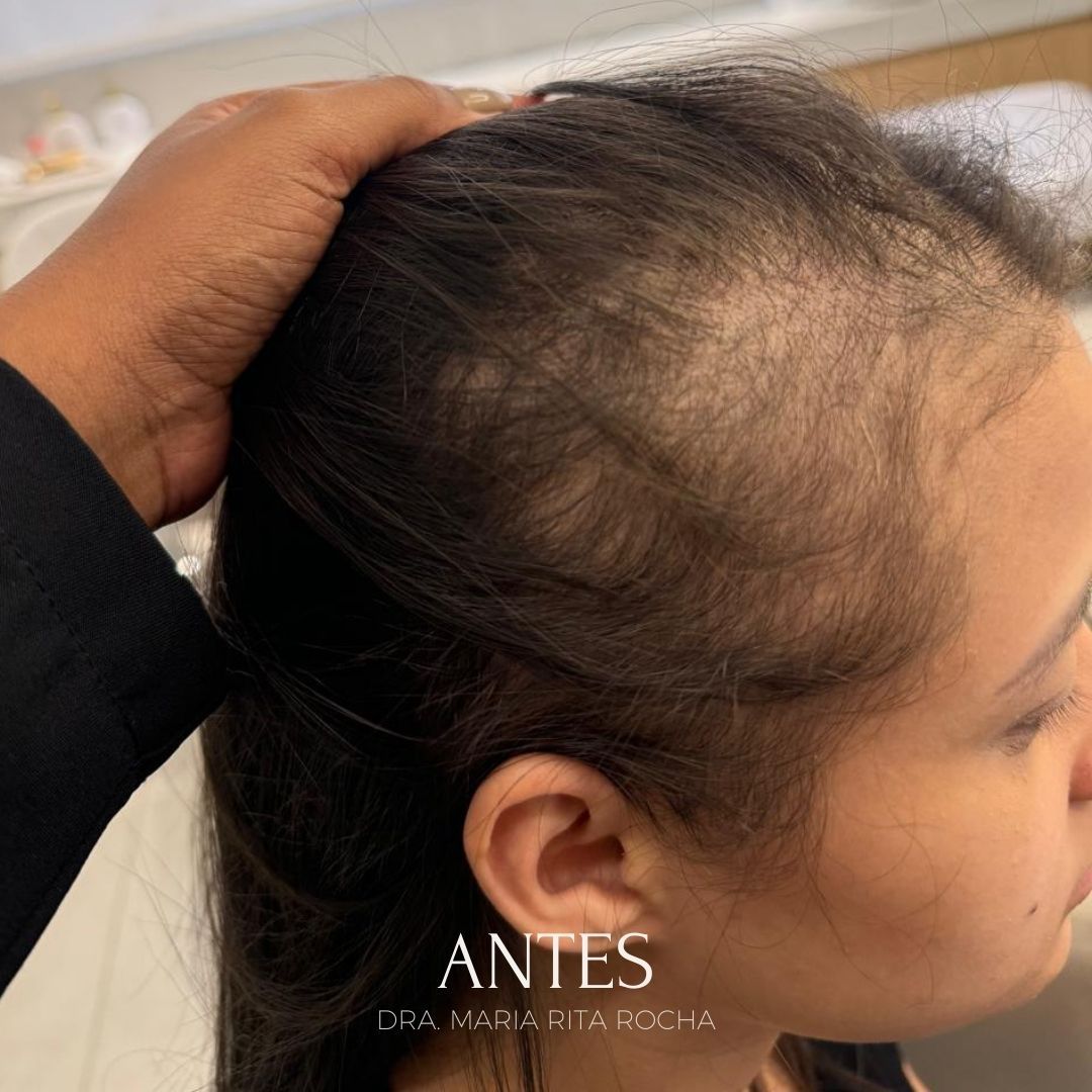 Antes — queda capilar pós-parto