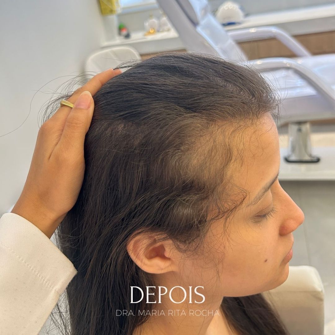 Depois — queda capilar pós-parto